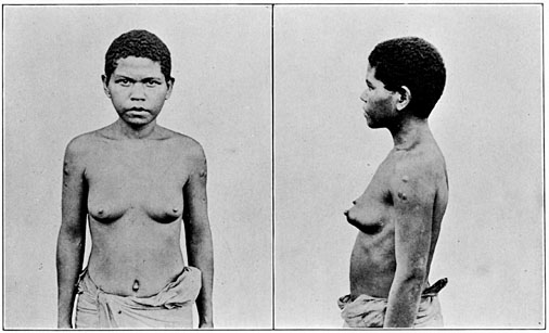 Negrito woman of Zambales, pure blood, showing scars made by blistering for fevers, etc.