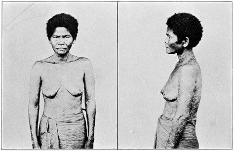 Negrito woman of Zambales, pure blood, showing skin disease.