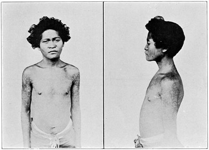 Negrito boy of Zambales, mixed blood, showing skin disease.