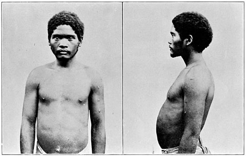 Negrito man of Zambales, mixed blood, showing skin disease.